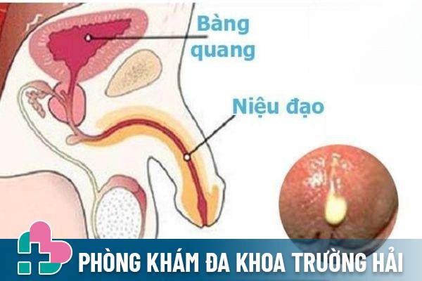 Tiểu có mủ là tình trạng bất thường gặp nhiều ở nam giới