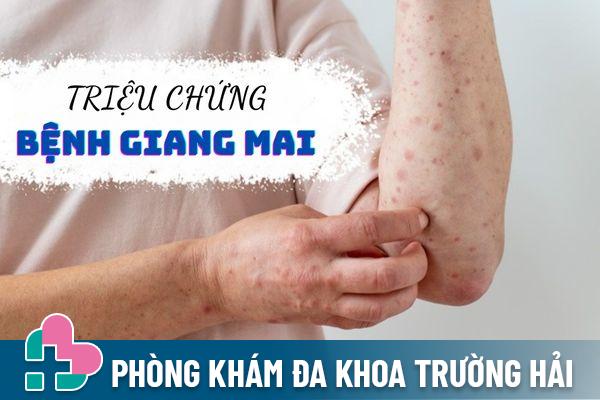 Triệu chứng bệnh giang mai như thế nào? Có nguy hiểm không?