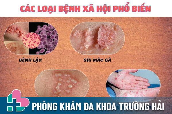 Một số loại bệnh xã hội phổ biến hiện nay