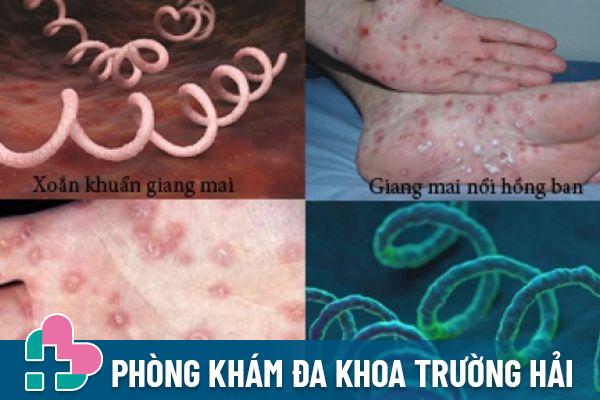 Giang mai là bệnh xã hội nguy hiểm phổ biến hiện nay