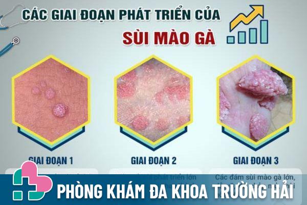 Các giai đoạn phát triển của bệnh sùi mào gà