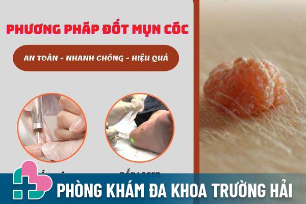 Phương pháp đốt mụn cóc hiệu quả, an toàn