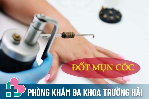 Phương pháp đốt mụn cóc hiệu quả, an toàn, không lo tái phát