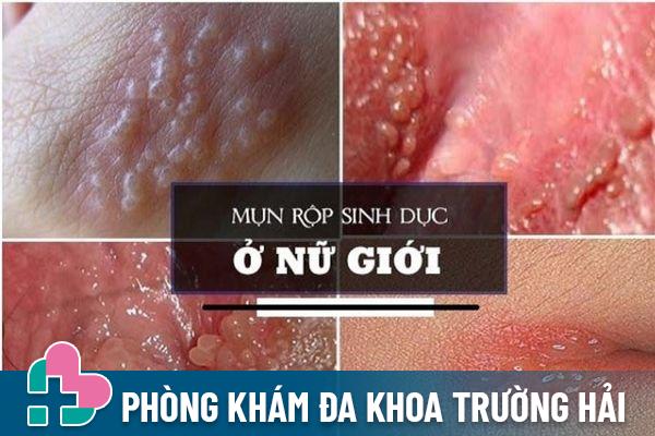 Hột le chảy mủ do bệnh mụn rộp sinh dục