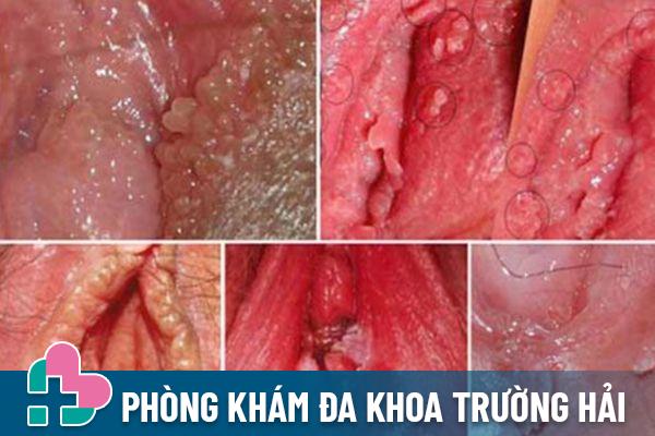 Sùi mào gà gây ra tình trạng hột le chảy mủ