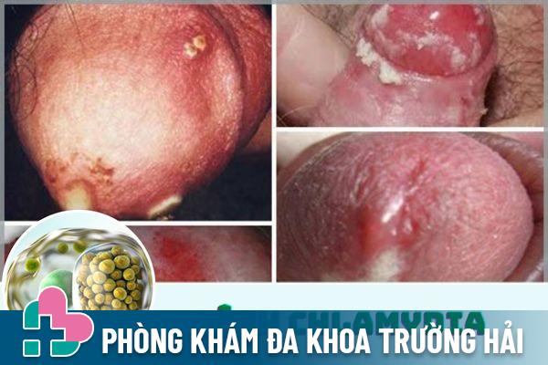 Bệnh CHlamydia gây ra triệu chứng chảy mủ bất thường ở lỗ sáo