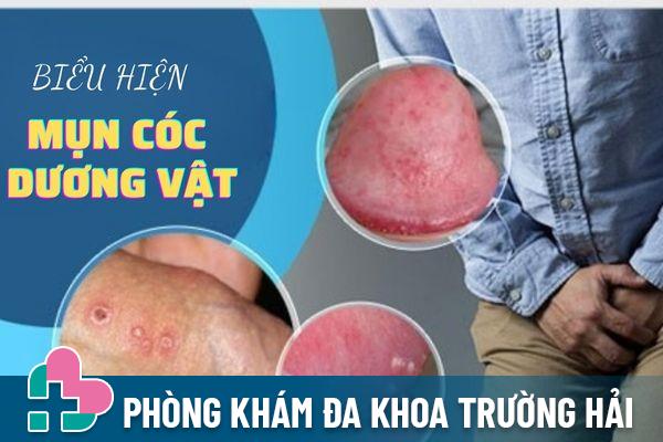 Triệu chứng bệnh mụn cóc dương vật nam giới