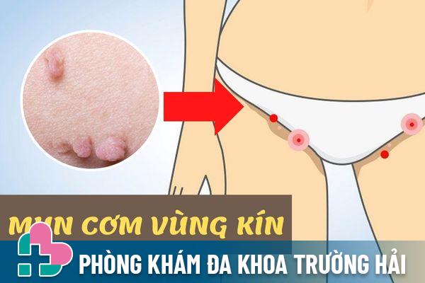 Mụn cơm vùng kín là gì? Có nguy hiểm không?