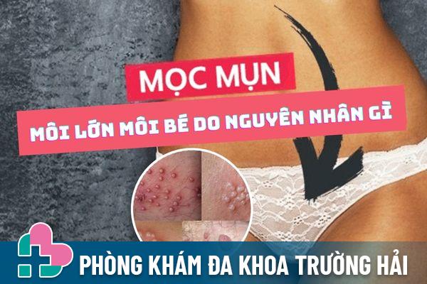 Mọc mụn môi lớn môi bé – Cảnh báo bệnh xã hội nguy hiểm