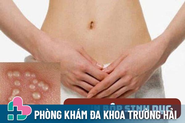 Mụn rộp sinh dục gây ra triệu chứng nổi mụn âm đạo