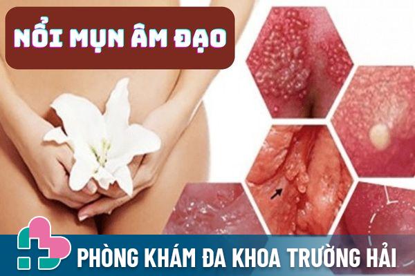 Nổi mụn âm đạo – Cảnh báo nhiều bệnh xã hội nguy hiểm