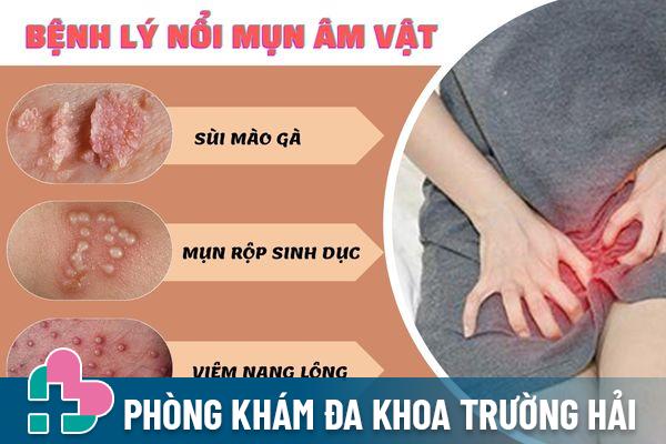 Các bệnh lý gây nổi mụn âm vật