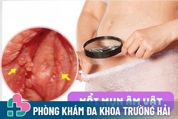 Nguyên nhân nổi mụn âm vật – Cách điều trị hiệu quả