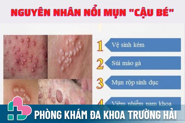 Nổi mụn cậu bé do nhiều nguyên nhân khác nhau gây ra