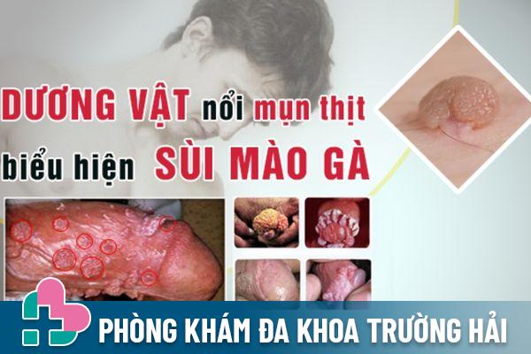 Nổi mụn ở dương vật là biểu hiện bệnh sùi mào gà