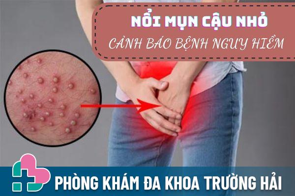 Nổi mụn cậu nhỏ do đâu? Phương pháp khắc phục hiệu quả