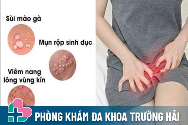 Nổi mụn cóc vùng kín ở là dấu hiệu cảnh báo nhiều bệnh lý nguy hiểm