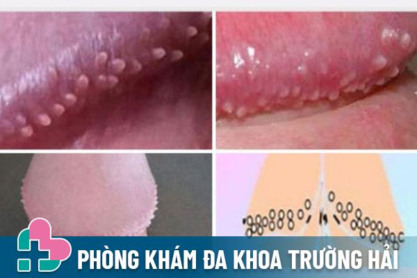 Chuỗi hạt ngọc dương vật là một trong những nguyên nhân mọc mụn vùng kín