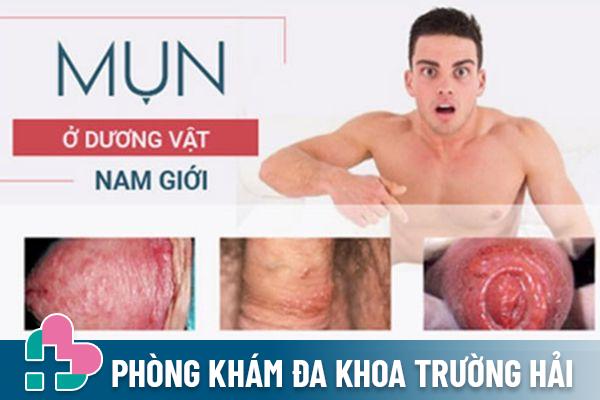 Cảnh báo bệnh lý khi nổi mụn dương vật bất thường