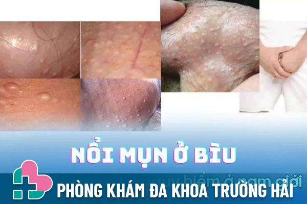 Cảnh báo bệnh nguy hiểm gây nổi mụn ở bìu