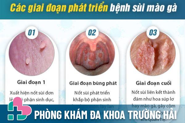 Nổi mụn ở cửa mình là dấu hiệu nhận biết bệnh sùi mào gà