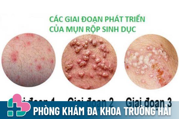 Mụn rộp sinh dục gây nổi mụn bất thường ở vùng kín nữ giới