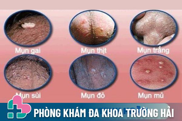 Các loại mụn thường gặp ở tinh hoàn nam giới