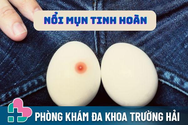 Nổi mụn tinh hoàn bị bệnh gì? Cách điều trị hiệu quả