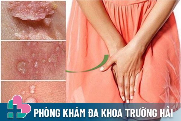 Nổi mụn trắng ở vùng kín cảnh báo bệnh sùi mào gà