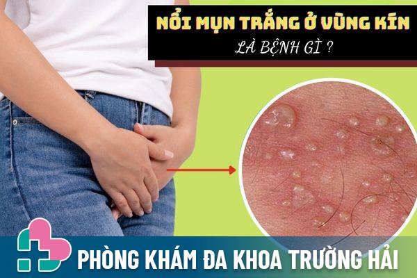 Nổi mụn trắng ở vùng kín là dấu hiệu của bệnh gì?