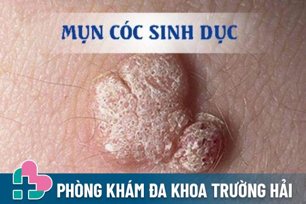 Mụn cóc sinh dục là bệnh lý thường gặp ở cả nam và nữ