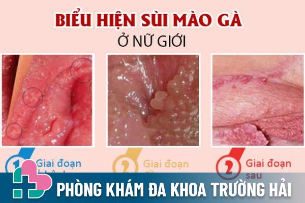 U nhú âm đạo là dấu hiệu nhận biết bệnh sùi mào gà