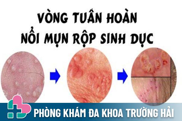 U nhú âm đạo do bệnh mụn rộp sinh dục gây ra