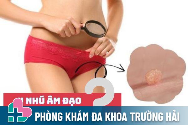 U nhú âm đạo ở nữ giới cảnh báo bệnh lý gì? Cách điều trị hiệu quả