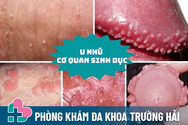 U nhú cơ quan sinh dục là bệnh lý khá phổ biến ở cả nam và nữ