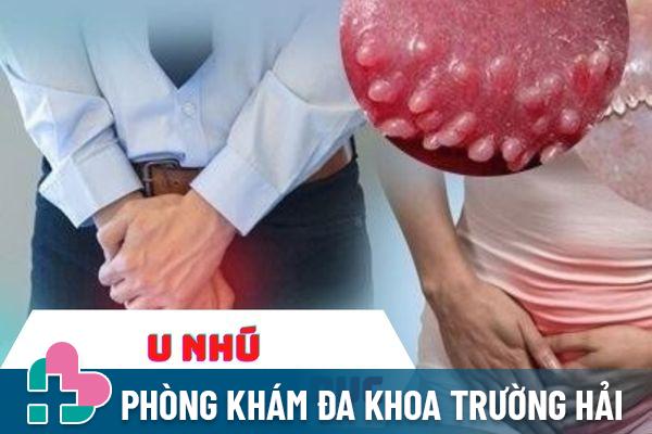 U nhú cơ quan sinh dục là gì – Cách điều trị hiệu quả