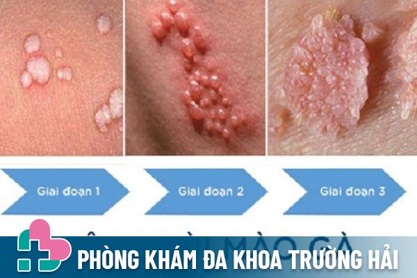 U nhú màu trắng đục là dấu hiệu cảnh báo bệnh sùi mào gà