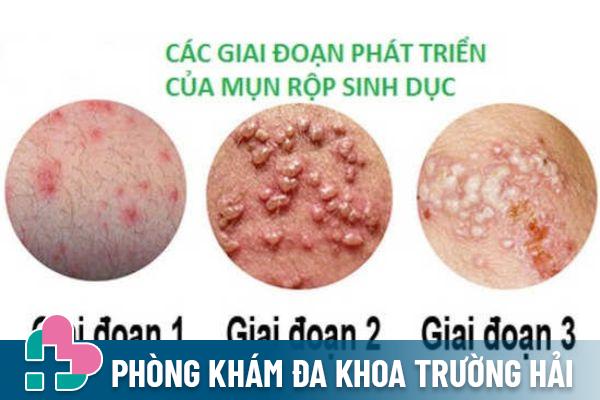 U nhú cảnh báo bệnh mụn rộp sinh dục