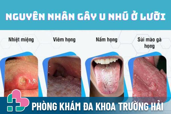 Có nhiều nguyên nhân gây ra tình trạng u nhú ở lưỡi