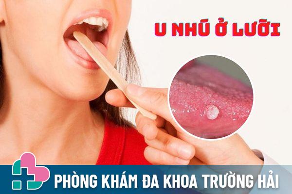 U nhú ở lưỡi cảnh báo bệnh lý gì? Có nguy hiểm hay không?