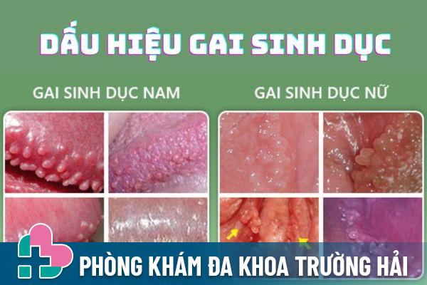 U nhú vùng kín là triệu chứng nhận biết bệnh gai sinh dục