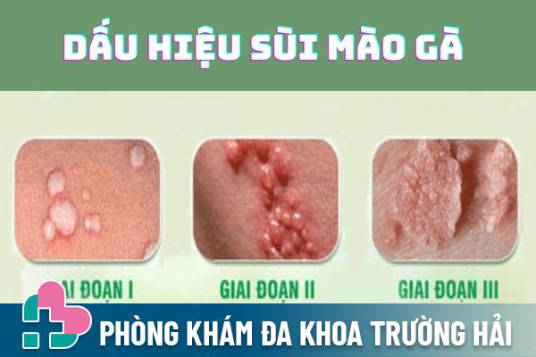 Triệu chứng bệnh sùi mào gà qua từng giai đoạn