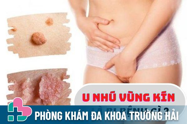 U nhú vùng kín là biểu hiện của bệnh gì?