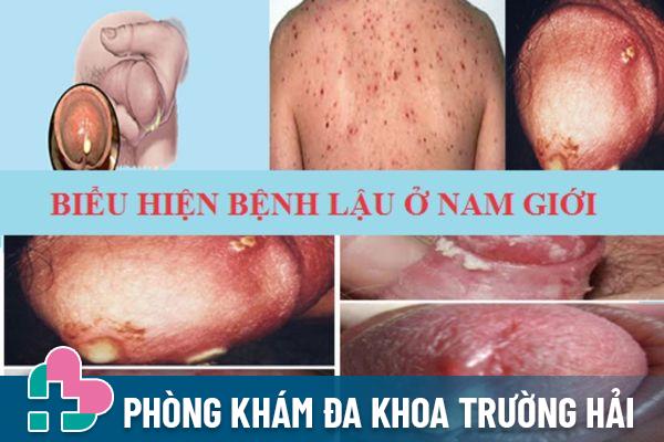 Vùng kín chảy dịch do bệnh lậu ở nam giới