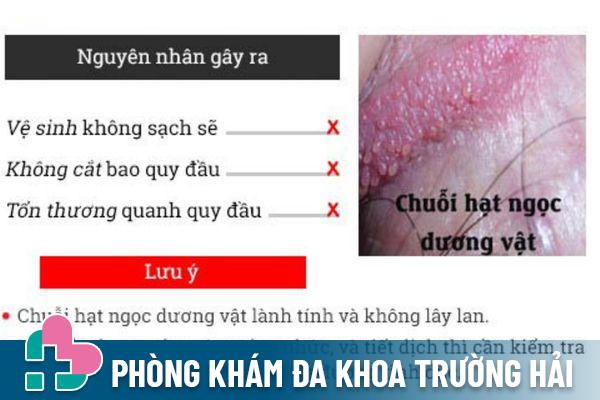 Hạt ngọc dương vật do nhiều nguyên nhân khác nhau gây ra