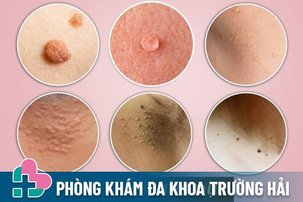 Triệu chứng bệnh mụn cơm sinh dục