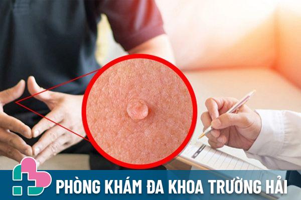 Địa chỉ điều trị mụn cơm sinh dục uy tín, chất lượng