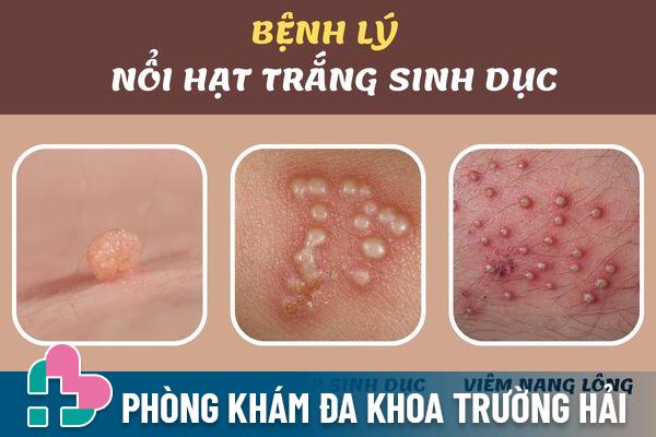 Nổi hạt trắng sinh dục cảnh báo nhiều bệnh lý nguy hiểm