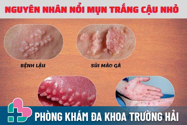 Nổi mụn trắng cậu nhỏ cảnh báo nhiều bệnh xã hội nguy hiểm 