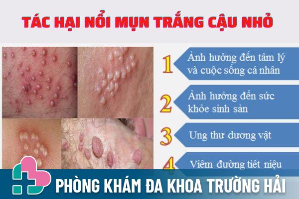 Tác hại của nổi mụn trắng ở cậu nhỏ